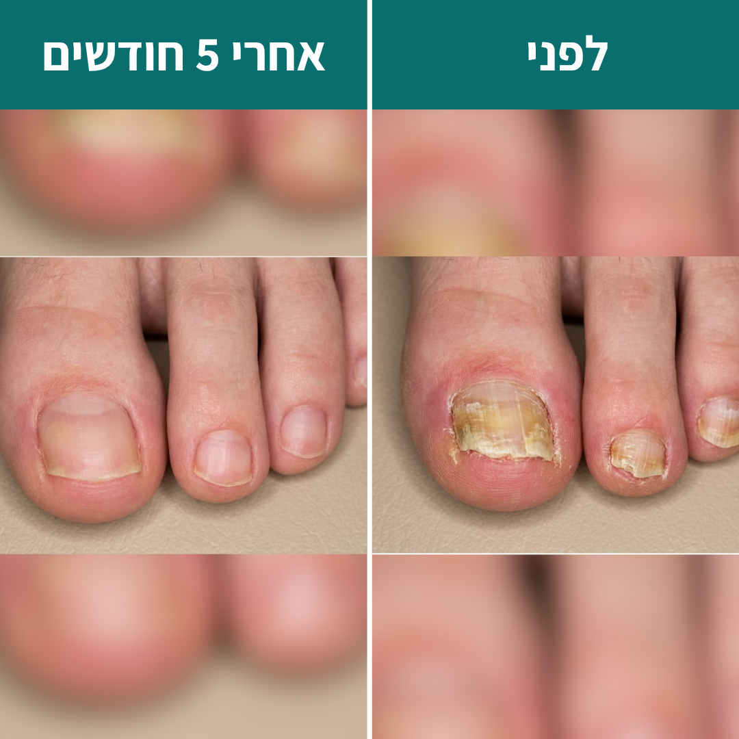 4 ב1 - הפרוטוקול של Renova לשיקום פטרת ציפורניים - תוצאות או החזר כספי מלא!
