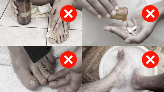 לייזר, תרופות אורליות או ערכת טיפול ביתית – מה עדיף לפטרת ציפורניים?