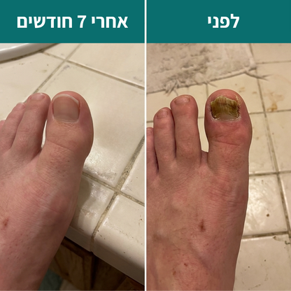 4 ב1 - הפרוטוקול של  Renova לשיקום פטרת ציפורניים - תוצאות או החזר כספי מלא!