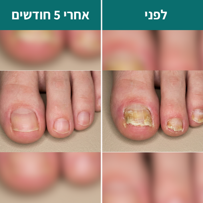 4 ב1 - הפרוטוקול של  Renova לשיקום פטרת ציפורניים - תוצאות או החזר כספי מלא!