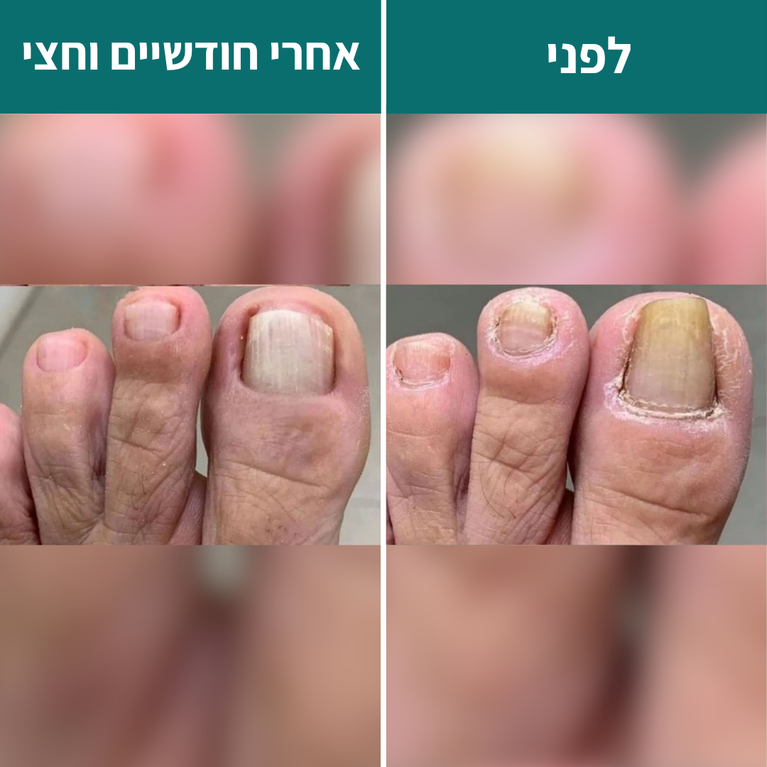 4 ב1 - הפרוטוקול של  Renova לשיקום פטרת ציפורניים - תוצאות או החזר כספי מלא!