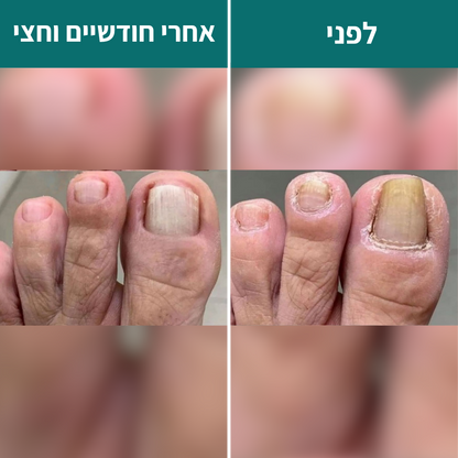 4 ב1 - הפרוטוקול של  Renova לשיקום פטרת ציפורניים - תוצאות או החזר כספי מלא!